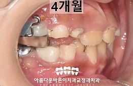 수술후