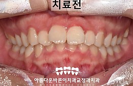 수술전