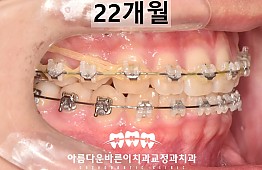 수술후