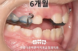 수술후