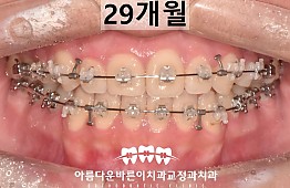 수술후