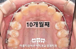 수술후