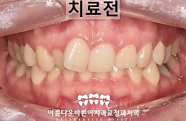 수술전