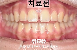 수술전