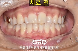 수술전