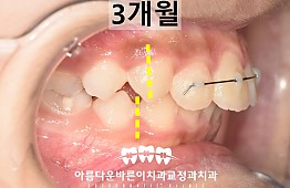 수술후