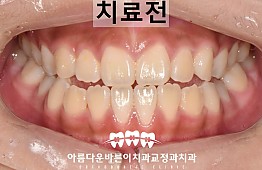 수술전