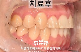 수술후