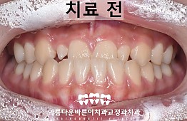 수술전