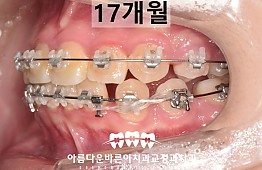 수술후