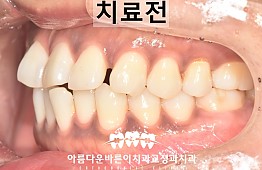 수술전