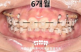 수술후