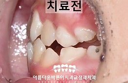 수술전