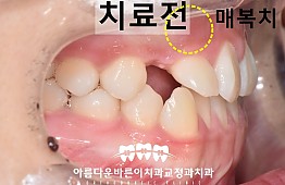 수술전