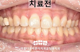 수술전