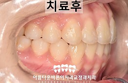 수술후